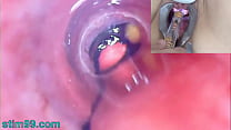 Caméra Endoscope Peehole Femme Mature dans la vessie avec des boules